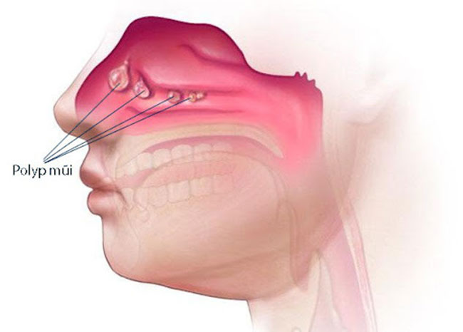 polyp-mui_1