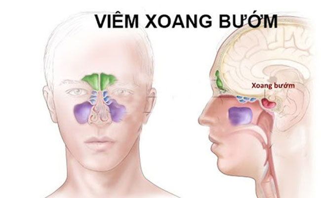 Viêm xoang bướm là gì? Nguyên nhân và triệu chứng